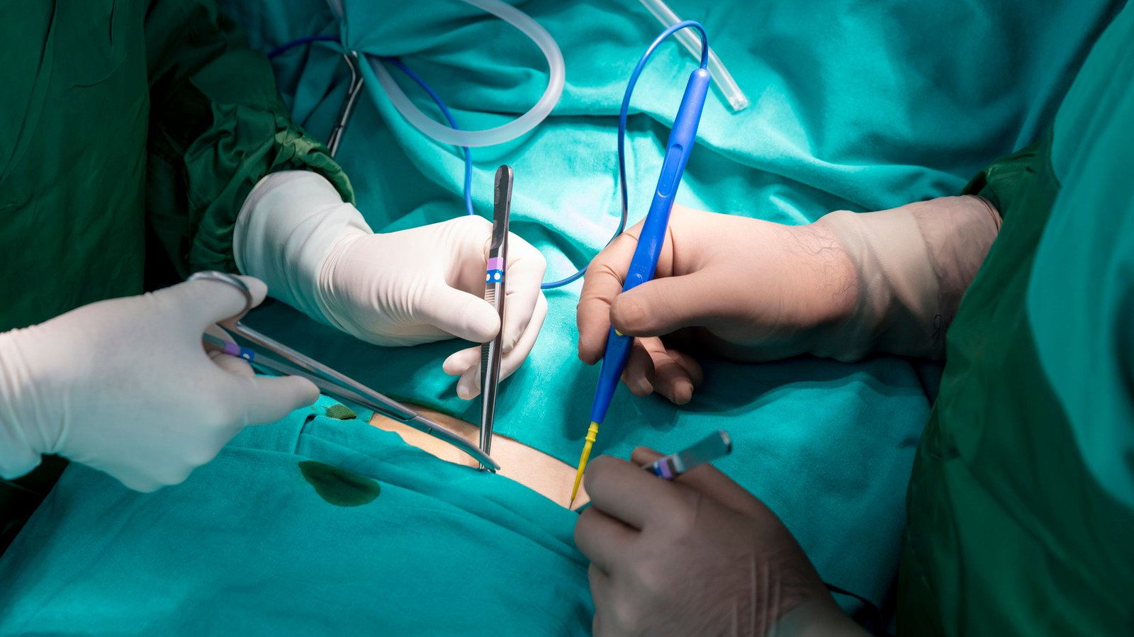 You Won't Die If You Have These 12 Organs Removed - Health Digest